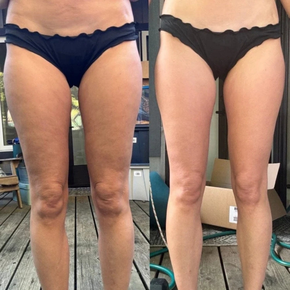 Roeboost™ - Anti-Cellulite Massager