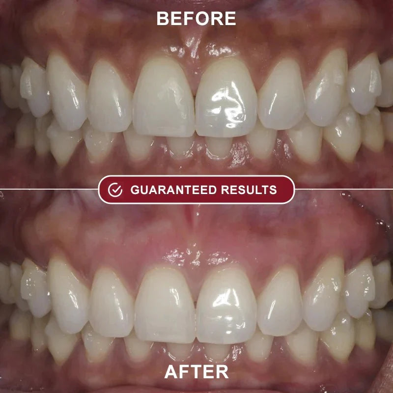 Roeboost™ - Teeth Whitening Kit