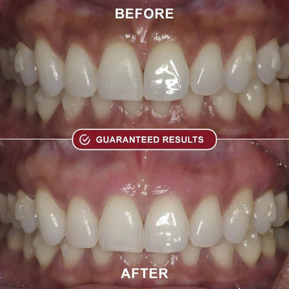 Roeboost™ - Teeth Whitening Kit
